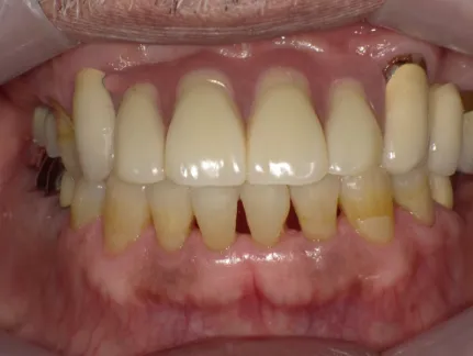 ミラクルデンチャー