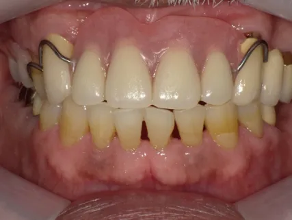 クラスプデンチャー