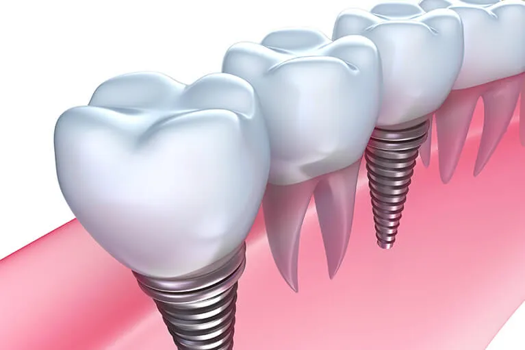 インプラントとは